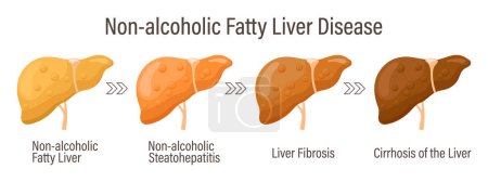 Illustration for Types of fatty liver. Human liver diseases. Non-alcoholic fatty liver disease. Hepatitis, liver cirrhosis, fibrosis, steatosis. Medical infographic banner. Vector - Royalty Free Image