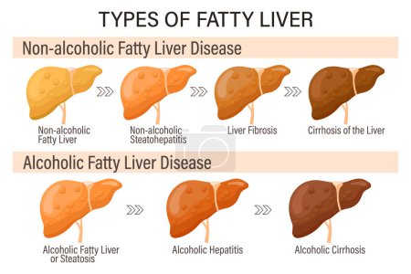 Illustration for Types of fatty liver. Human liver diseases. Alcoholic and non-alcoholic fatty liver. Hepatitis, liver cirrhosis, fibrosis, steatosis. Medical infographic banner. Vector - Royalty Free Image
