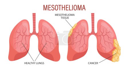Estadios del mesotelioma, enfermedad pulmonar. Salud. Banner de infografía médica, ilustración, vector