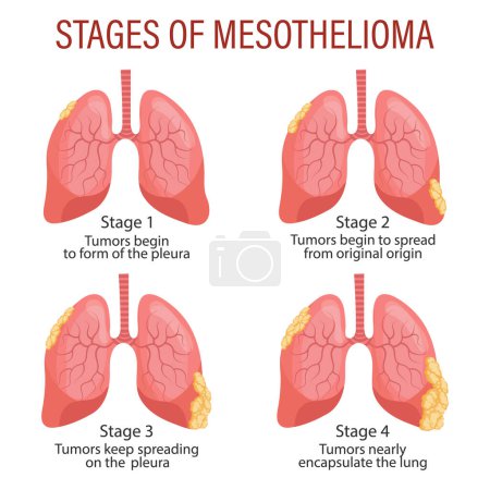 Illustration for Stages of mesothelioma, lung disease. Healthcare. Medical infographic banner, illustration, vector - Royalty Free Image