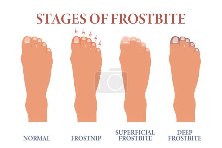 Frozen toes. Stages of frostbite of fingers. Healthcare and medicine. Vector
