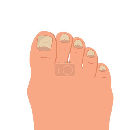 Illustration for Swollen toe, onychocryptosis. Foot with nail disease or infection. Foot with onychomycosis or nail fungus. Healthcare and medicine. Vector - Royalty Free Image