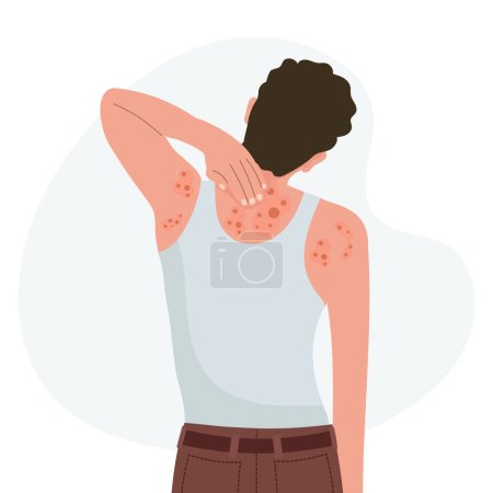 Illustration for Allergic itching, skin inflammation, redness and irritation. Atopic dermatitis, eczema, psoriasis. Healthcare and medicine. Vector - Royalty Free Image