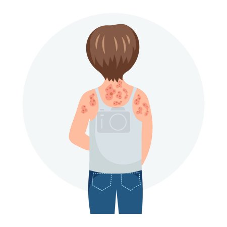 Illustration for Allergic itching, skin inflammation, redness and irritation. A child with allergies. Healthcare and medicine. Vector - Royalty Free Image