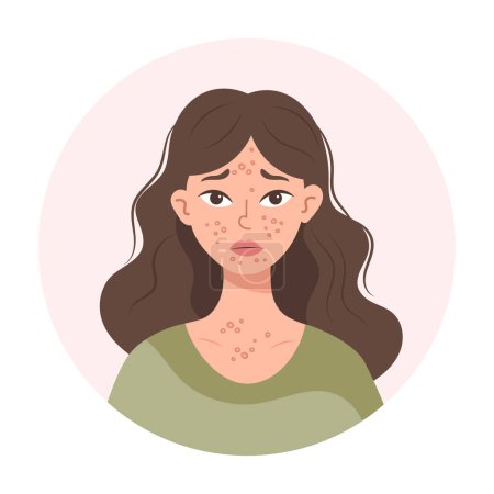 Akne. Unglückliches Teenager-Mädchen mit Akne und Pickeln im Gesicht. Gereizte Gesichtshaut. Abbildung, Vektor