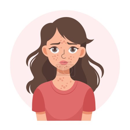 Acné. Adolescente infeliz con acné y granos en la cara. Piel facial irritada. Ilustración, vector
