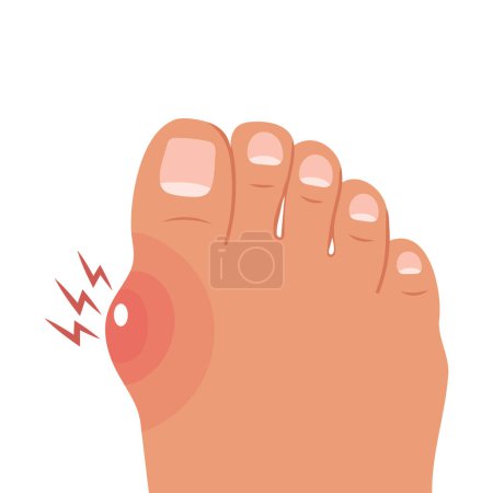 Foot with painful bunion. Healthy and sick feet. Healthcare and medicine. Illustration. Vector