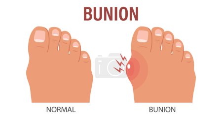 Foot with painful bunion. Healthy and sick feet. Healthcare and medicine. Illustration. Vector