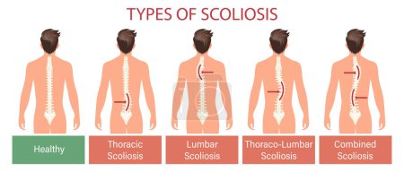 Tipos de escoliosis, enfermedad espinal. Banner de infografías con columna vertebral para escoliosis humana. Salud y medicina. Ilustración, póster