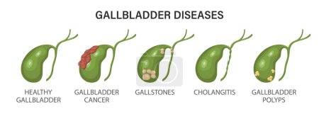 Gallbladder diseases infographics. Gallstone disease, cancer, acute cholecystitis, cholangitis or polyps of the digestive system. Problems with the biliary tract. Illustration.