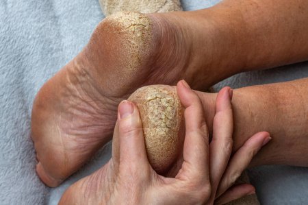 Cracks on the heels of a person's foot, foot health problems, neglected heel of a person. A doctor examines a man's cracked heels. Close-up. The concept of treating cracked heels.