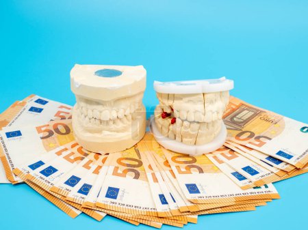 Photo for Dental casts and banknotes on a blue background. Plaster model of teeth. Close-up. - Royalty Free Image