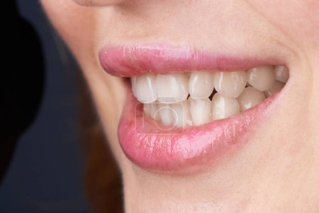 Makroaufnahmen von Zähnen mit schönen Lippen, die Veneers zeigen