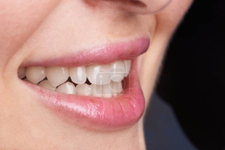 Makroaufnahmen von Zähnen mit schönen Lippen, die Veneers zeigen.