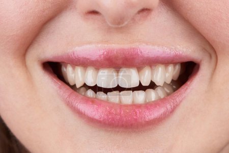 Foto de Macro fotografía de dientes con hermosos labios, mostrando carillas. - Imagen libre de derechos