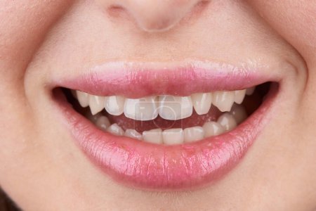 Makroaufnahmen von Zähnen mit schönen Lippen, die Veneers zeigen.