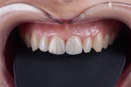 Téléchargez les photos : Macro photographie de dents avec placages, prise de vue avant - en image libre de droit
