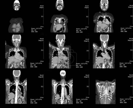 Téléchargez les photos : Ct scanner l'abdomen, la poitrine et le corps de la vue avant par balayage IRM. radiologie médicale. - en image libre de droit