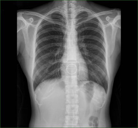 Téléchargez les photos : Images radiographiques de la poitrine du patient, poumon pour le diagnostic médical. - en image libre de droit