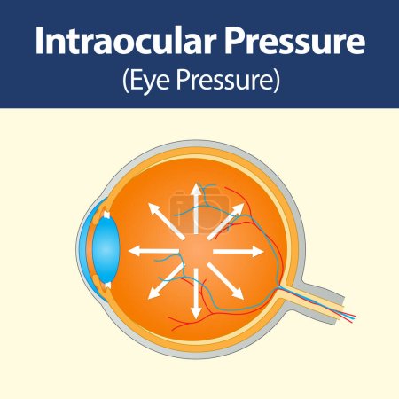 Ilustración de Sección del ojo humano que muestra la acumulación de presión intraocular en la enfermedad de Glaucoma. - Imagen libre de derechos