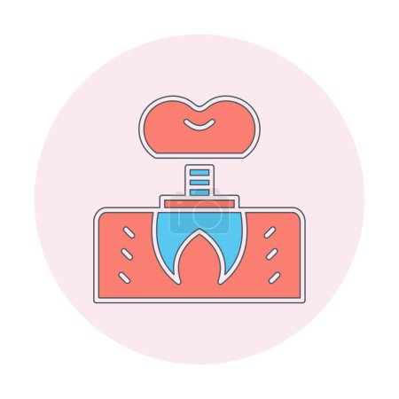 Téléchargez les illustrations : Image vectorielle de contour de l'icône de l'implant dentaire. - en licence libre de droit