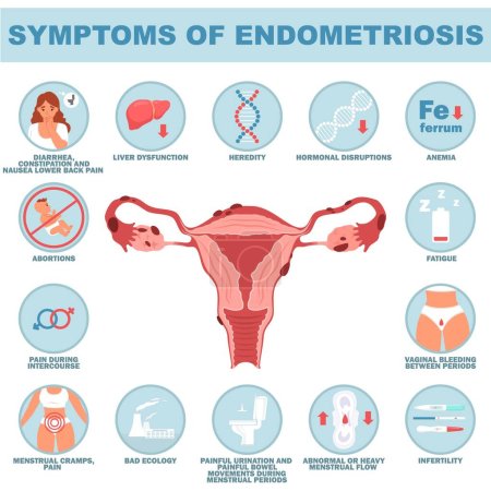 Illustration for Symptom of endometriosis reproductive system disease medical vector illustration with sick woman and womb with endometrial elements outgrowth - Royalty Free Image
