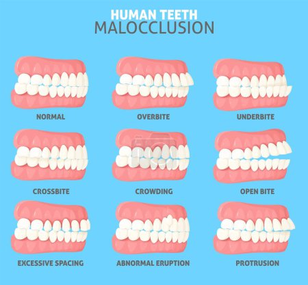 Tipos de maloclusión establecidos con vista lateral de normal, desalineación y relación incorrecta entre dientes humanos de ilustración de vectores de mandíbula superior e inferior