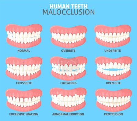Téléchargez les photos : Différents types de malocclusion des dents humaines définissent l'illustration vectorielle. Affiche médicale avec les gens bouche mâchoires avec occlusion normale et anormale vue de face - en image libre de droit