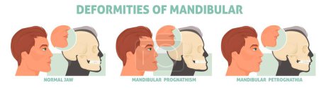 Illustration for Deformities of mandibular with normal jaw, prognathism and petrognathia symptom medical poster vector illustration. Cranio defects, facial cosmetic disorder - Royalty Free Image