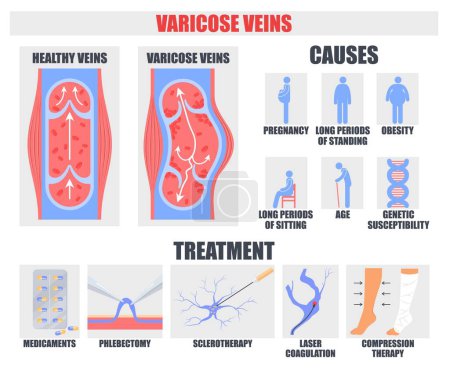 Varicose vein disease causes and treatment methods medical poster vector illustration. Health problem and instrument to prevent and cure disorder
