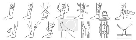 Varicose vein disease symptom, treatment medical infographics elements. Outline patient legs with different advice to prevent disorder development and to cure vessel inflammation vector illustration