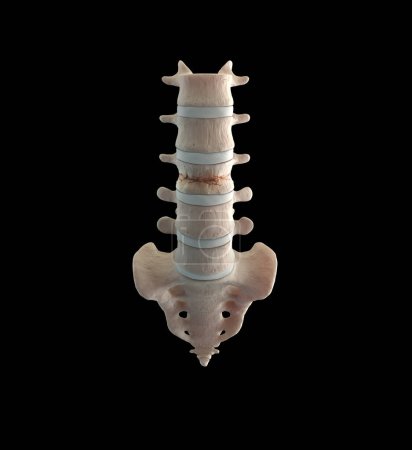 Foto de Fractura de compresión lumbar esqueleto - Imagen libre de derechos
