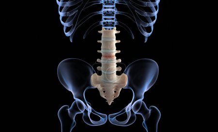 Photo for Lumbar compression fracture injury on black background - Royalty Free Image