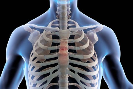 Foto de Ilustración médica 3D del esqueleto con el esternón roto - Imagen libre de derechos