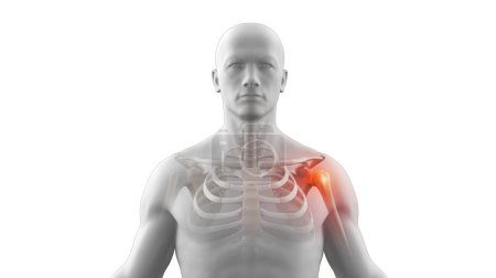 Foto de Esqueleto de rayos X humanos con lesión en la articulación del hombro - Imagen libre de derechos