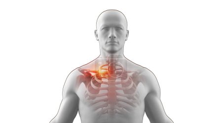 Foto de Ilustración médica 3d del esqueleto humano con una clavícula rota - Imagen libre de derechos