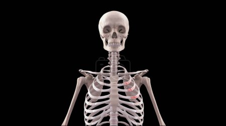 3d medical illustration of human skeleton with fractured ribs