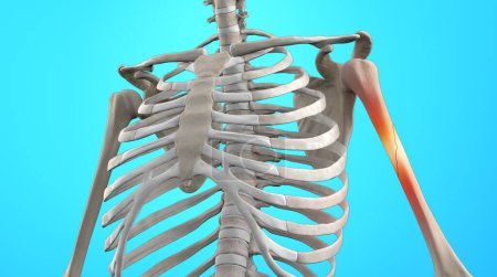 3D medical illustration of human skeleton with broken humerus