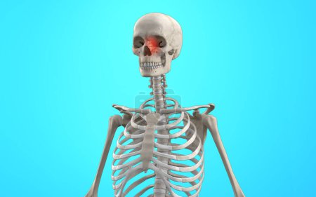 Téléchargez les photos : Squelette humain avec fracture du visage orbital - en image libre de droit