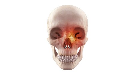 Téléchargez les photos : Squelette humain avec fracture du visage orbital - en image libre de droit
