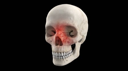Human skeleton with orbital face fracture