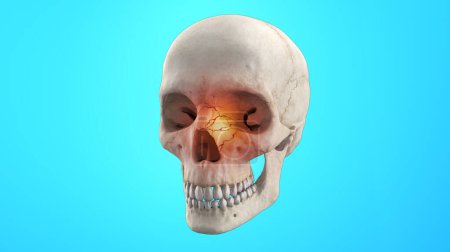Human skeleton with orbital face fracture