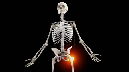 Foto de 3d ilustración médica del esqueleto humano con dolor en las articulaciones de la cadera - Imagen libre de derechos