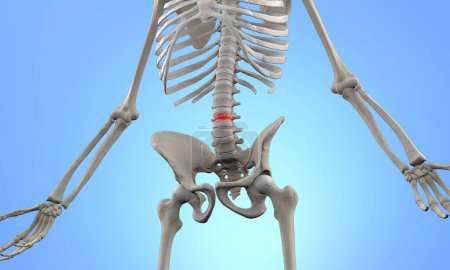 Medical illustration of human skeleton with lumbar compression fracture injury