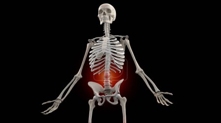 Foto de Ilustración médica del esqueleto humano con estenosis lesión lumbar - Imagen libre de derechos