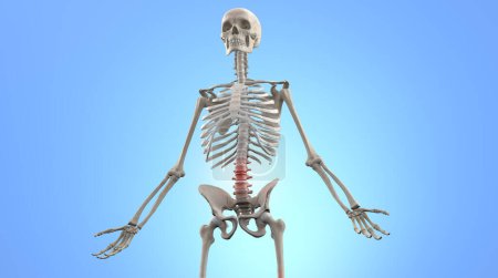 Foto de Ilustración médica del esqueleto humano con estenosis lesión lumbar - Imagen libre de derechos