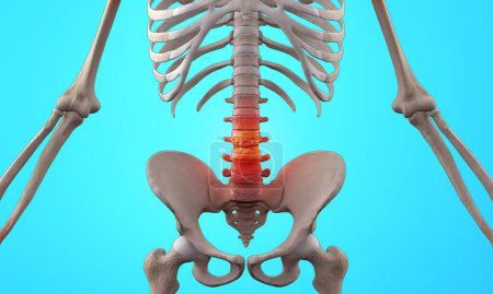Foto de 3d ilustración médica del esqueleto humano con lesión lumbar - Imagen libre de derechos