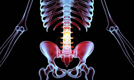 Foto de 3d ilustración médica del esqueleto humano con lesión lumbar - Imagen libre de derechos