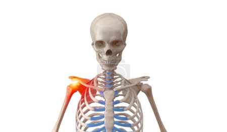 Photo for Human x-ray skeleton with shoulder joint injury - Royalty Free Image