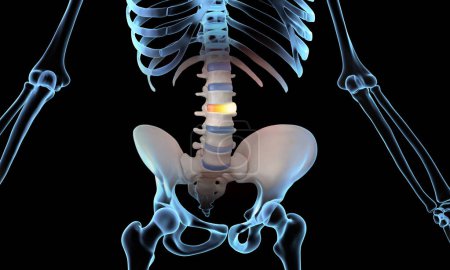 Bulging disc spinal injury skeleton medical illustration
